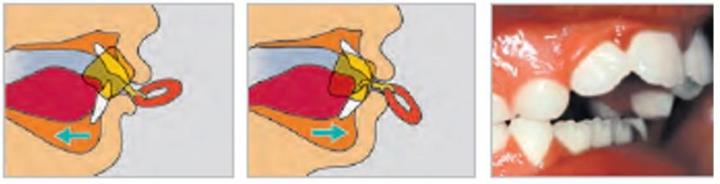 pantalla oral para corregir la mordida 