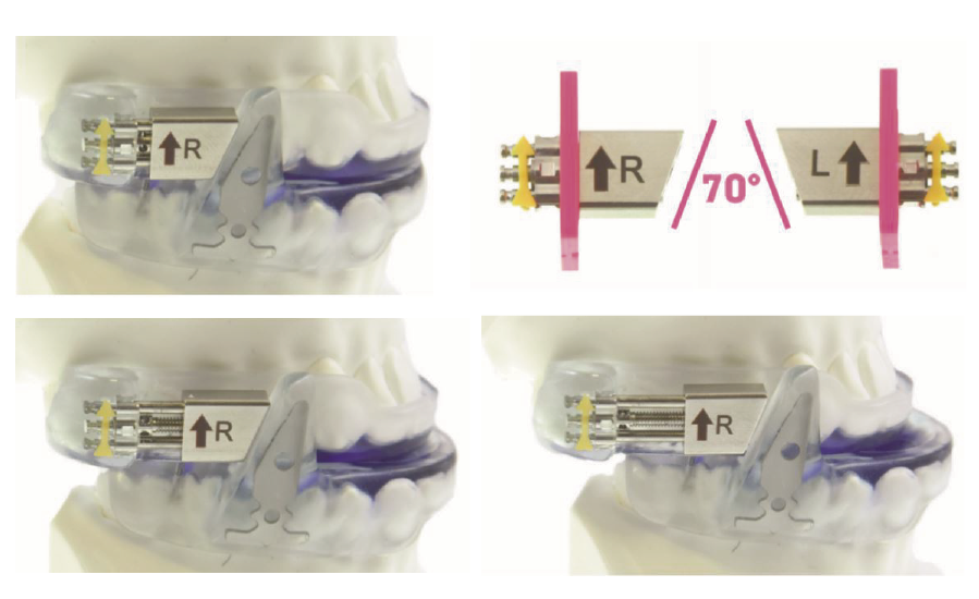 Dispositivos antironquidos para la lengua de silicona, para detener la  apnea del sueño, alivio de la boca de la apnea del sueño, dispositivo de  avance