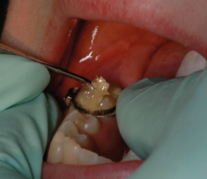 como elegir el mejor cemento de bandas para tratamientos de ortodoncia con brackets