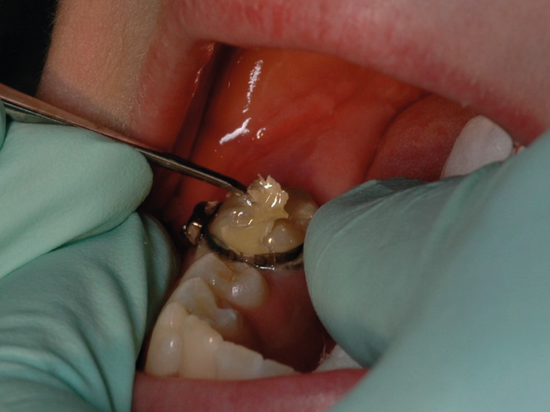 como elegir el mejor cemento de bandas para tratamientos de ortodoncia con brackets