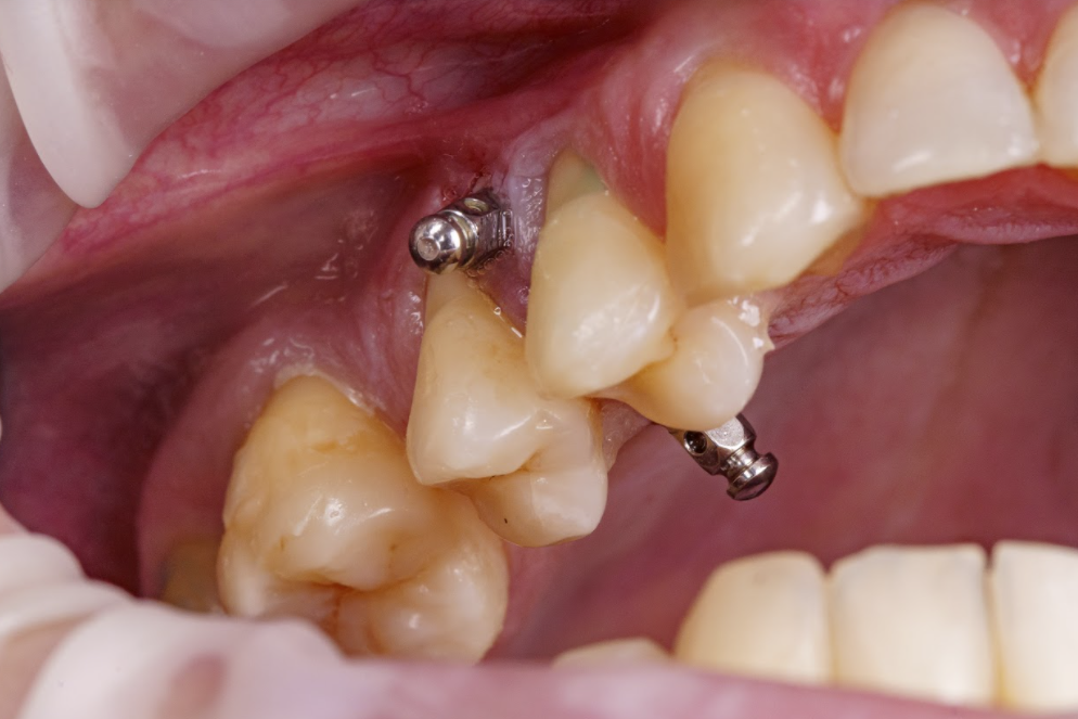 colocación de un microtornillo distal en el último molar - secretaligner -proclinic