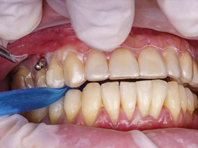 Microtornillos y ortodoncia invisible secret aligner proclinic