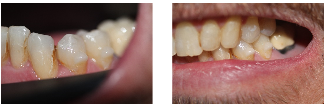 composite omnichroma estetica dental perfect a smile