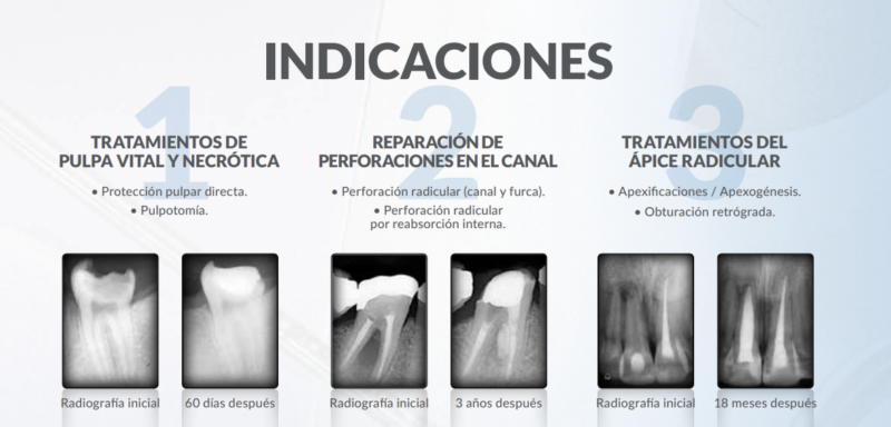 Todo lo que debes saber sobre cementos dentales – DentalDoktor