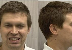 evaluacion facial secret aligner