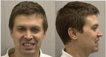 evaluacion facial secret aligner