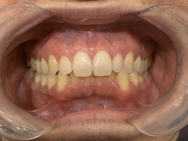 Clase I molar derecha, III izquierda. Clase I canina bilateral. Compresión dentoalveolar bimaxilar acompañada de apiñamiento anteroinferior severo.
