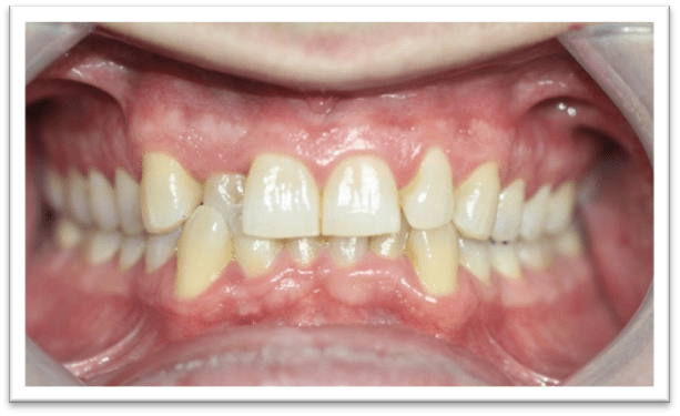 SCompresión dentoalveolar