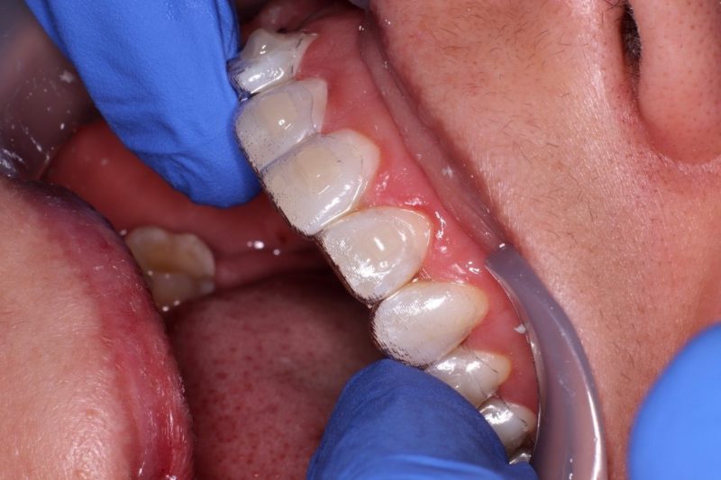 Cómo Colocar la férula - Reliance Orthodontic