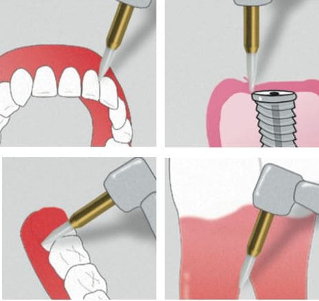 hemorragia dental