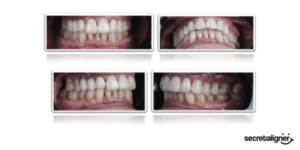 ¿Es posible tratar pacientes periodontales con alineadores?