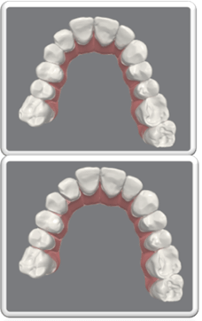 tratar pacientes periodontales con alineadores