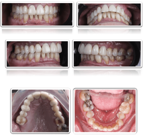 tratar pacientes periodontales con alineadores