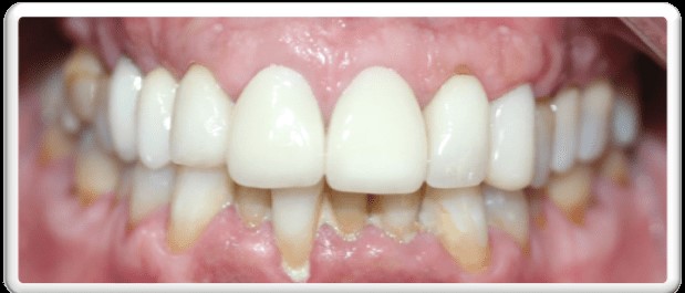 ortodoncia invisible en pacientes periodontales