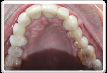 ortodoncia invisible en pacientes periodontales . Arcada superior