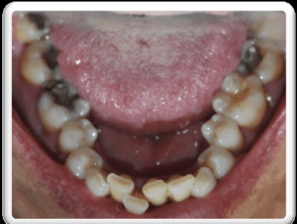 ortodoncia invisible en pacientes periodontales . Arcada inferior