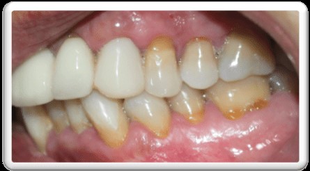 ortodoncia invisible en pacientes periodontales . Mordida