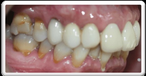 ortodoncia invisible en pacientes periodontales . Mordida