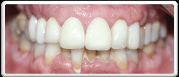 pacientes periodontales con alineadores SecretAligner