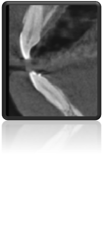 torque anterior