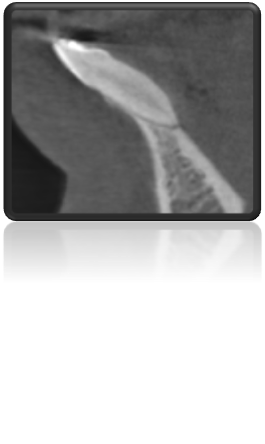 torque anterior