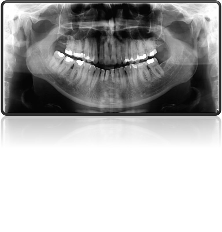 torque anterior