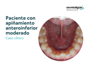 Caso clínico: paciente con antecedente de ortodoncia fija, que presenta apiñamiento anteroinferior moderado.