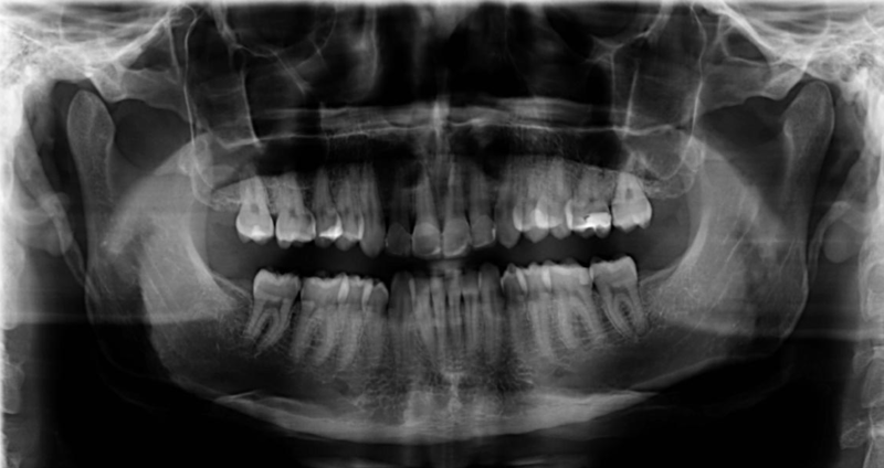 caso clínico de un paciente con antecedente de ortodoncia fija, que presenta apiñamiento anteroinferior moderado