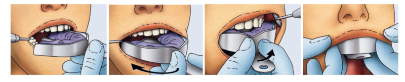 correcta toma de impresion dental