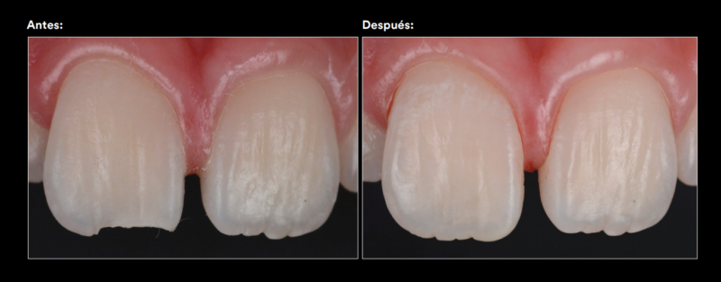fractura de esmalte marginal caso clínico con productos 3m