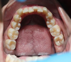 apiñamiento dental caso clinico con alineadores invisibles