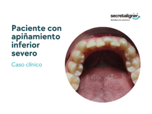 ¿Cómo corregir apiñamiento severo en adulto con alineadores invisibles?: Caso clínico