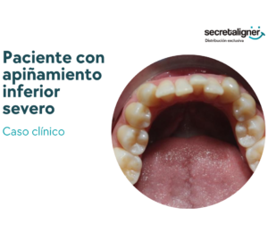 caso clinico d epaciente con apiñamiento severo dientes inferiores