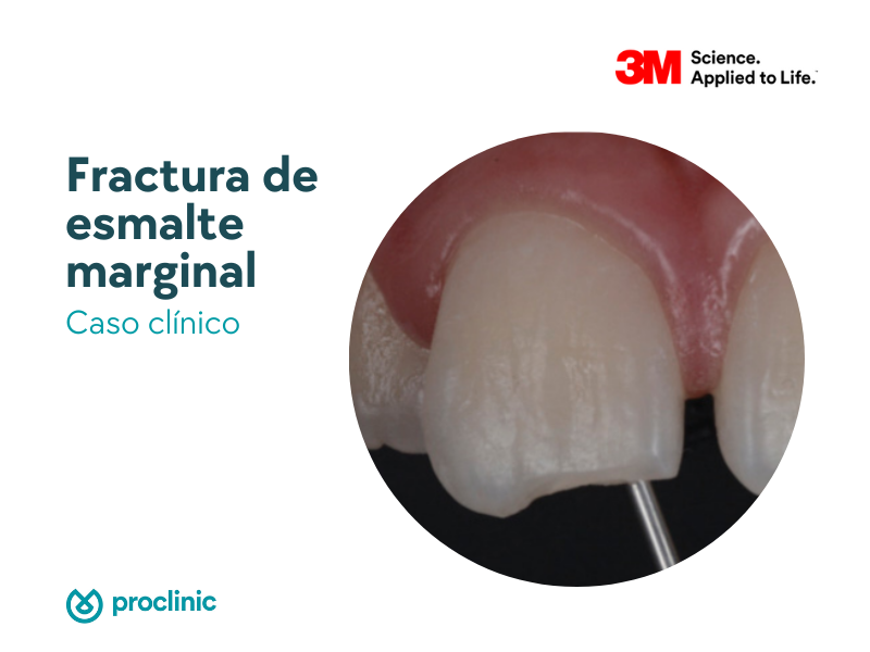 fractura-de-esmalte-marginal-caso-clinico-con-productos-3m-proclinic