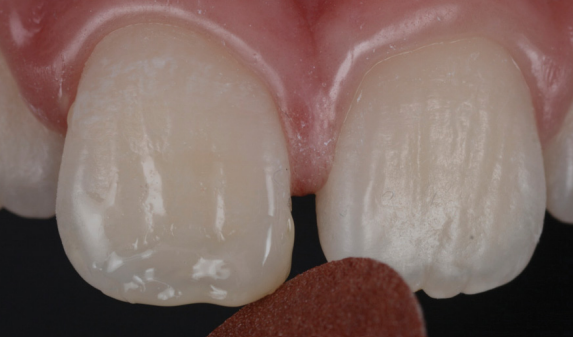 aspecto del diente tras aplicacion y fotopolimerizacion con productos 3m
