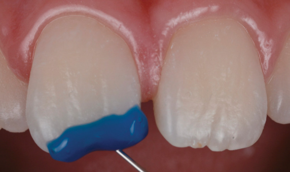 limpieza de dente con disco de acabado y pulido 3m