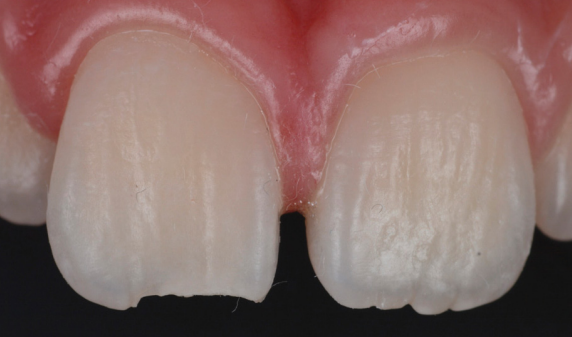 fractura de esmalte marginal caso clinico