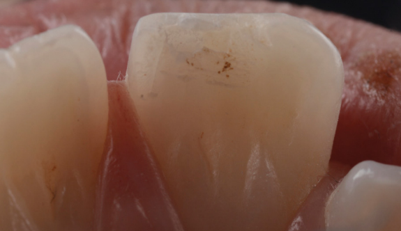 escasa estructura dental por fractura de esmalte