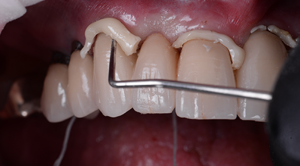 ¿Cómo simplificar la cementación dental?