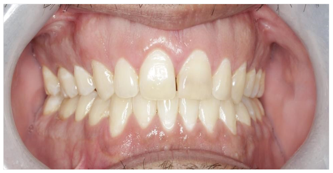 caso clinico resolucion recidiva de ortodoncia fija con alineadores invisibles foto de frente