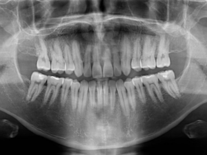 Resolución de recidiva de un tratamiento de ortodoncia fija. Caso clínico SecretAligner
