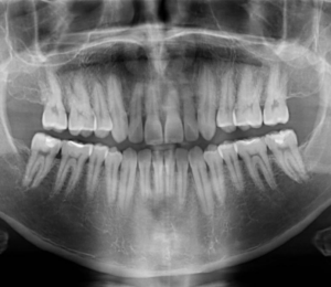 caso clinico resolucion recidiva de ortodoncia fija con alineadores invisibles