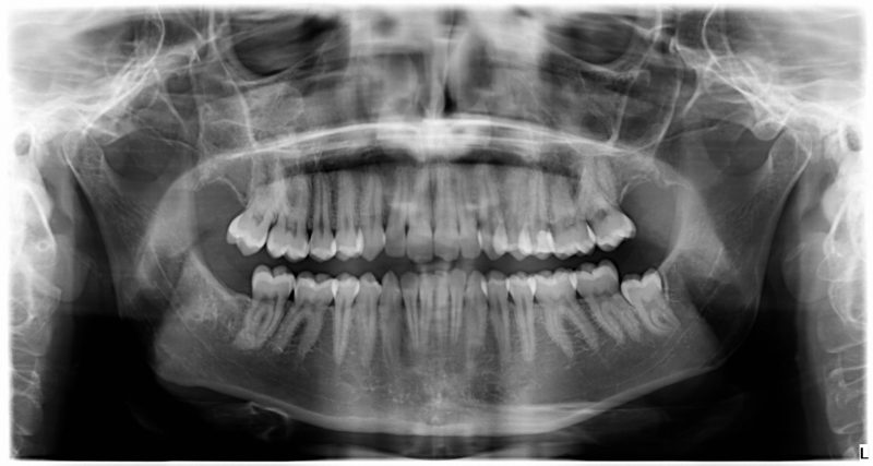 radiografía panorámica ausencia de terceros molares 18 ,28 y 48, 38 retenido en el hueso mandibular