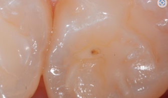 manchas provocadas por  burbujas en la restauracion dental