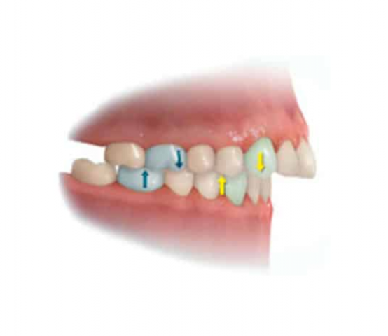 maloclusion dental tipo 2 corregir con dbar