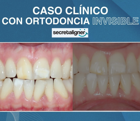 caso clinico paciente con mordida clase secret aligner ortodoncia invisible