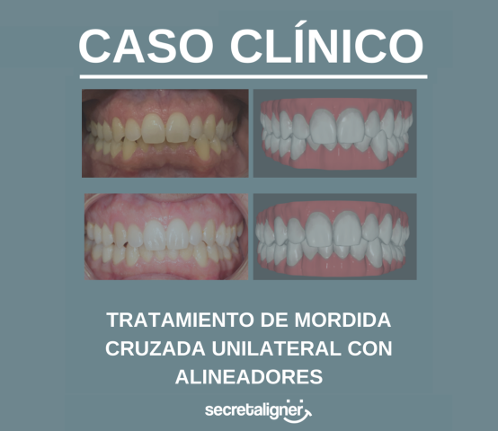 Tratamiento de mordida cruzada unilateral con alineadores secretaligner: reporte de un caso