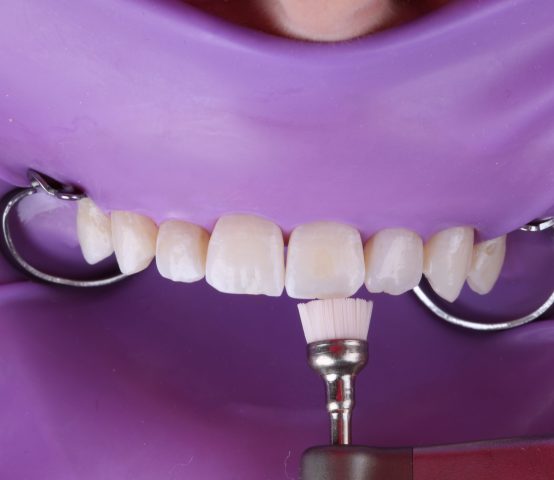 Caso clinico con Filtek Easy Match y Scotchbond Universal Plus