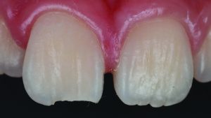Protegido: Composites fluidos: Dónde encajan en su flujo de trabajo dental