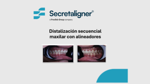 Distalización secuencial maxilar con alineadores